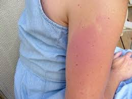 How bad does laser hair removal hurt? Side Effects Of Laser Hair Removal 5 Facts You Should Know Storat