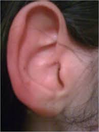 Red Ear Syndrome Precipitated By A Dietary Trigger A Case Report Journal Of Medical Case Reports Full Text