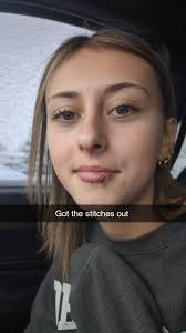 Teenager bitten by doberman pincher heals well