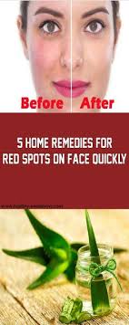 Pimples are red spots on the skin, chest, and upper back that form when pores become blocked by oil and dead skin cells. Pin On Beauty Tips