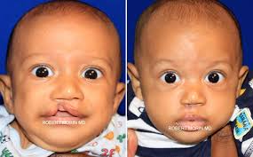 Image result for Cleft Lip