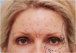 Check spelling or type a new query. Frontalis Treatment With Botox Springerlink