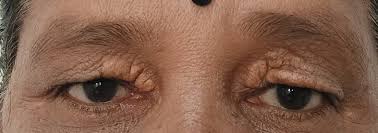 Image result for xanthelasma of eyelid