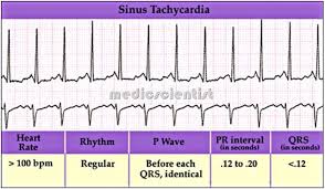 Paroxysmal supraventricular tachycardia (psvt) last updated may 7, 2018. Psvt Paroxysmal Supraventricular Tachycardia Tachyarrhythmias Sinus Tachycardia Medicscientist Total Health Portal Quality Generic Medicines