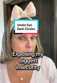 Effective Solutions for Under Eye Dark Circles