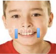 Kinesio Tape in Speech Therapy