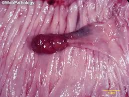 Image result for Colonic Polyp