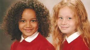Remember These Rare Twins With Different Skin Colors? This is How They Look  Now!