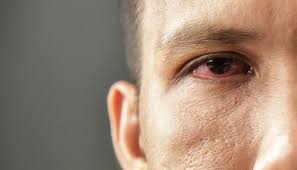 Dacryocystorhinostomy Treatment For A Blocked Tear Duct Johns Hopkins Medicine