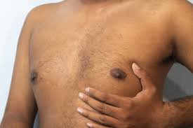 Image result for Gynecomastia