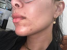 12 yr old son has started getting horrible breakouts. Thinking of trying  the detox mask microdermabrasion scrub and spot treatment. He has a face  wash but we need more help… what should