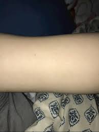 Upon close inspection, you realize that these red dots aren't they are blood vessels above the surface of the skin, come with age (though there's an isolated. Tiny Red Pinpoint Dots On My Arms Hi I Have Been My Skin