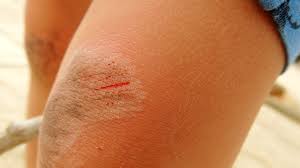 Warm tap water is recommended for cleaning most wounds. Why Petroleum Jelly May Not Be The Best Thing To Heal Cuts Bbc News