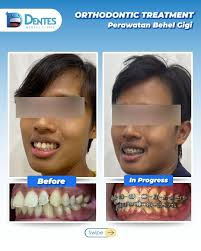 Lagi bingung mau pasang behel Damon atau behel biasa? Keduanya bagus untuk  merapikan gigi, tapi beda banget dari sistem kerja sampai kenyamanan. .  Damon: tanpa karet, lebih modern, nyaman & efisien Biasa: