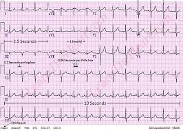 Approach To Ecg Interpretation How To Interpret A 12 Lead