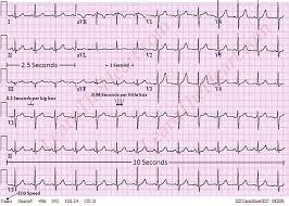 Approach To Ecg Interpretation How To Interpret A 12 Lead