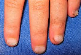 Image result for Koilonychia feet