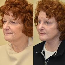 Incredibly happy for this sweet patient of mine. She underwent endoscopic  brow lift, upper blepharoplasty, and lower face and neck lift surgery. Now  she looks the way she feels inside. I love