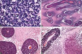 Retinoblastoma histopathology is a combination of undifferentiated cells and areas of tumor differentiation shown as rosettes and fleurettes. Jaypeedigital Ebook Reader