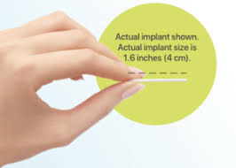 • nexplanon has replaced implanon in the uk because of cases of incorrect insertion of implanon by clinicians. Arm Implant Birth Control Std Free Los Angeles Nexplanon