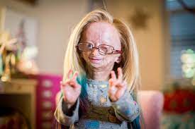 What Is Progeria Causes Symptoms And Treatment Of Rare Benjamin Button Ageing Condition Affecting Youtuber Adalia Rose