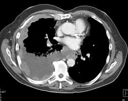 A new technique called ct perfusion can show if cancer cells are spreading in the bloodstream. Mesothelioma Right Pleural Space Chest Case Studies Ctisus Ct Scanning