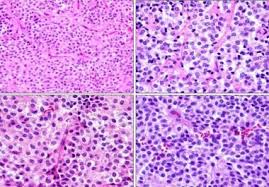 Histology Of Pituitary Adenoma Pituitary Adenomas Pituitary Gland Tumor Pituitary Gland Anterior Pituitary