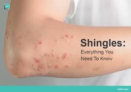 Maybe you would like to learn more about one of these? Shingles Causes Symptoms Risk Factors Treatment Halza