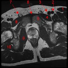 The muscle that forms the major part of the pelvic diaphragm. Atlas Of Mri Of The Male Pelvis W Radiology