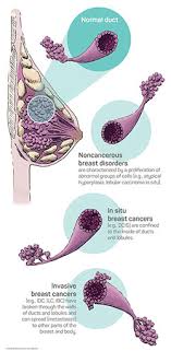 Types of breast cancer, inflammatory breast cancer & stages. Breast Cancer Facts Seattle Cancer Care Alliance