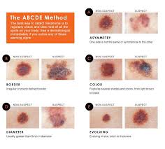 If breast cancer is diagnosed at an early enough stage, it's treatable. How To Spot The Early Signs Of Melanoma Skin Cancer Babyface