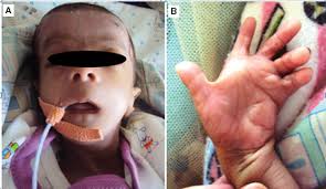 In another medical condition, peroxisomal disorder, a flat nasal bridge came with the associated epicanthal. Zellweger Syndrome Prenatal And Postnatal Growth Failure With Epiphyseal Stippling