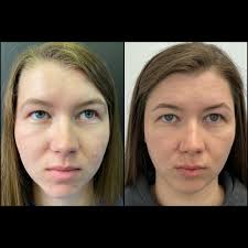 Stacey Koch, APRN. Nurse Injector