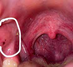 So erkennt man die verdickung am hals beispielsweise bei einer erkältung. Wovon Kommt Das An Der Wange Innen Gesundheit Und Medizin Allergie Hals
