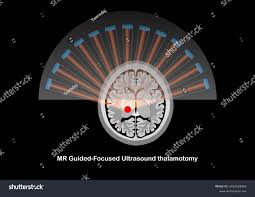 Image result for Thalamotomy