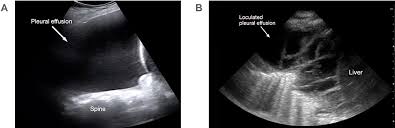Rather, any underlying disease that has been identified (congestive heart failure thoracic ultrasound for pleural effusion in the intensive care unit: Lung Ultrasound In Children With Respiratory Tract Infections Viral Oaem
