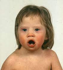 Common physical signs of down syndrome include 1,2: Down Syndrom Trisomie 21 Gesundheitsprobleme Von Kindern Msd Manual Ausgabe Fur Patienten