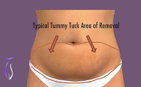 Modern clinic, experienced & uk certified surgeons, 24/7 personal assistance. Tummy Tuck Area Of Removal La Jolla San Diego Tim Sayed Md Facs