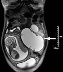While ovarian cancer has the lowest survival rate for all cancers, 92 per cent of patients will. A Giant Hydronephrosis Mistakenly Diagnosed As Ovarian Tumor In A Pregnant Woman Sciencedirect