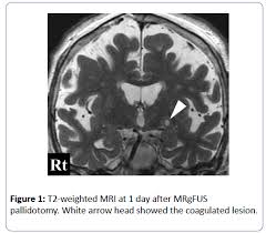 Image result for Pallidotomy