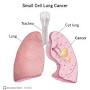 small cell lung cancer lymph nodes from my.clevelandclinic.org