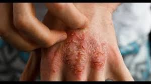 Sintomas do novo coronavírus costumam surgir cinco, seis dias após o contágio. Dermatite Atopica Sintomas Causas E Tratamentos Sbd Resp