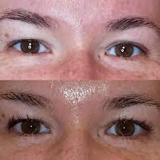 No discomfort or discoloration, and my lashes have definitely gotten much longer than when i was using maybelline lash serum alone (now i use sg, wait 15 min, and also apply maybelline serum just because haha). Best Eyebrow Growth Serum Reddit
