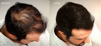 Anyone troubled by hair loss should see a dermatologist. Maxx Pro Series Volumizing Hair Fibers With Real Keratin For Thinning Hair Hair Loss Dermatologist Tested And Certified Hypoallergenic 60 Days Supply Multiple Colors Available Light Brown Buy Online