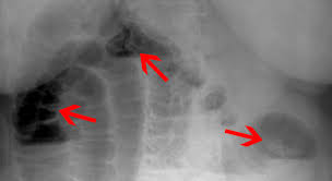 In den allermeisten fällen ist der darmverschluss bei einem baby oder kleinkind auf mechanische ursachen zurückzuführen. Darmverschluss Ileus Invagination Beim Kleinkind