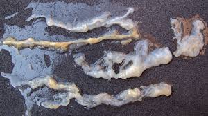 Image result for thin ribbon stools human poop