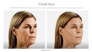 The frown lines or glabella lines is the most popular area treated with neuromodulator injections. Juvederm Before And After Pictures Juvederm Westport Ct