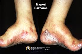 Image result for Sarcoma