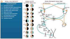 Image result for Visual Field Deficit