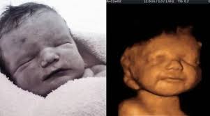 Mãe sempre protegeu seu "sorridente" bebê dos pedidos abortistas dos médicos